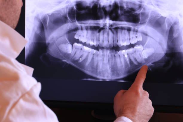 Best Emergency Wisdom Teeth Removal in Helena Valley West Central, MT